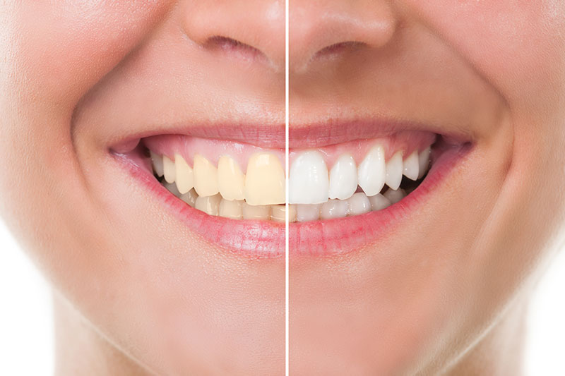 Teeth Whitening - Leilani S. Alarcon, DDS, Escondido Dentist